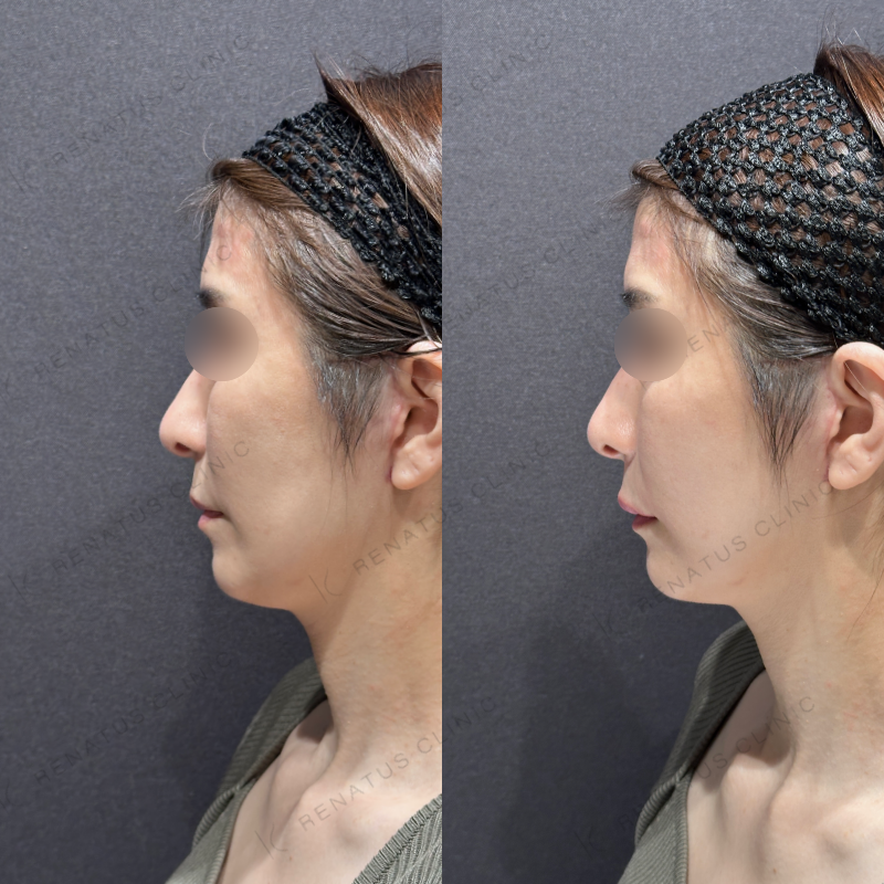 上唇ヒアルロン酸ボルベラ症例写真