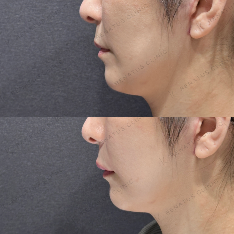 上唇ヒアルロン酸ボルベラ症例写真