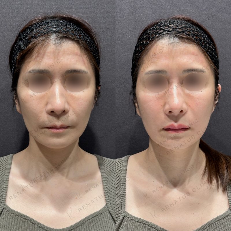 上唇ヒアルロン酸ボルベラ症例写真