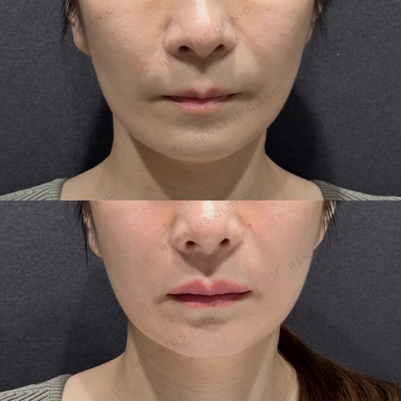 上唇ヒアルロン酸ボルベラ症例写真
