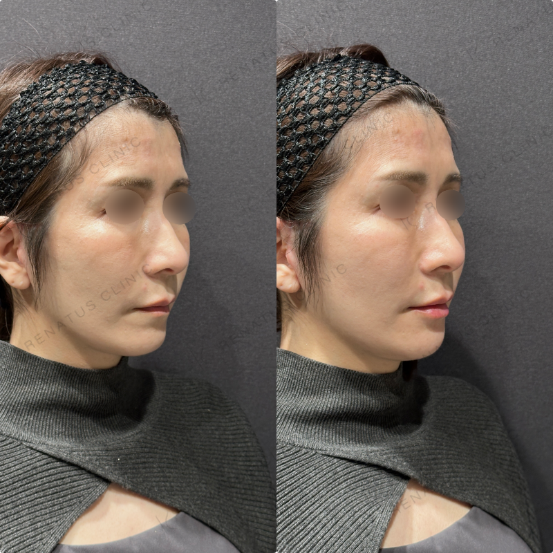 唇ヒアルロン酸ボルベラ症例写真