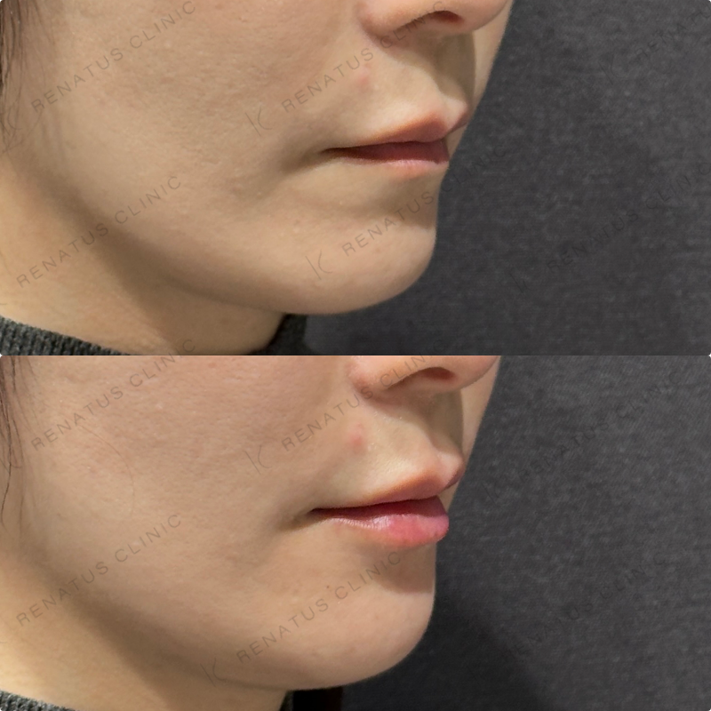 唇ヒアルロン酸ボルベラ症例写真
