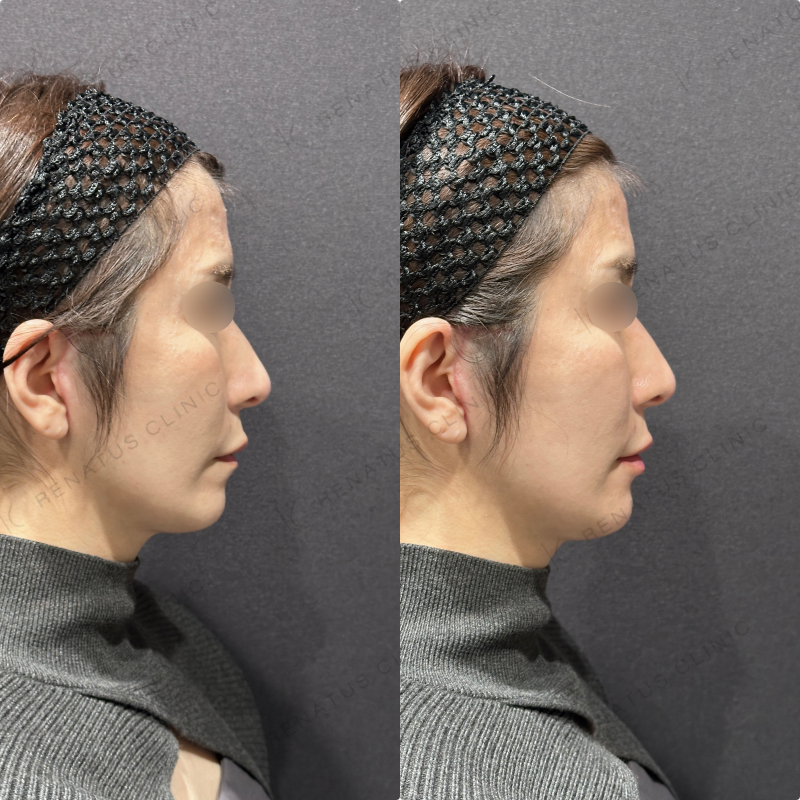 唇ヒアルロン酸ボルベラ症例写真