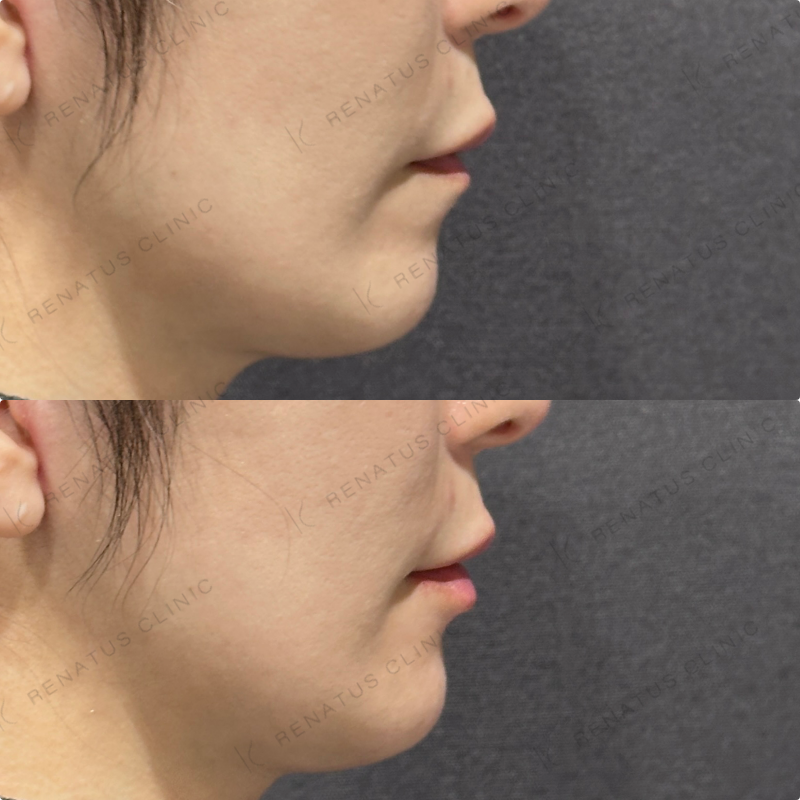 唇ヒアルロン酸ボルベラ症例写真