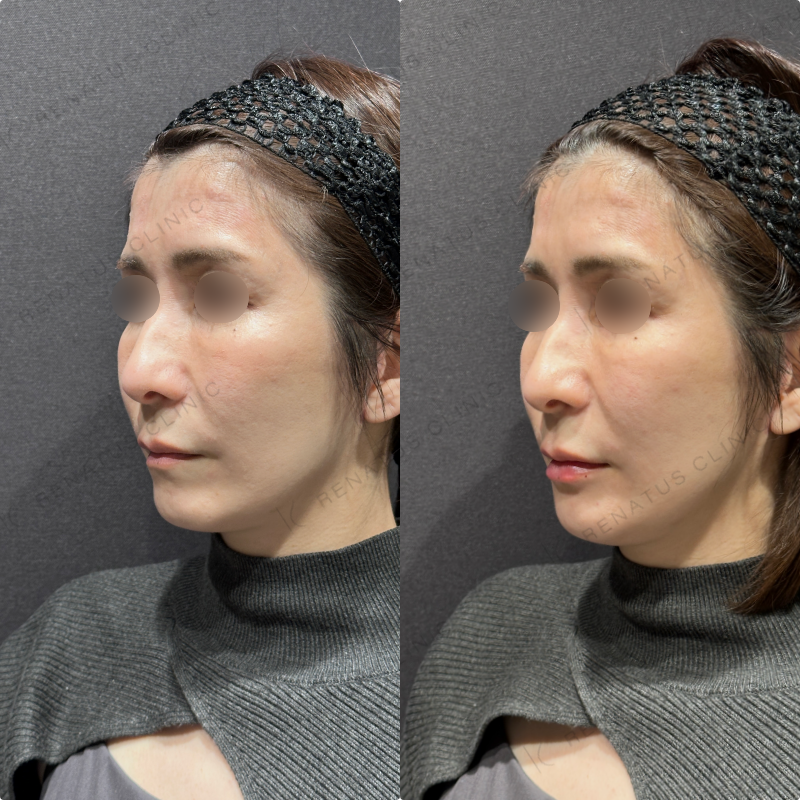 唇ヒアルロン酸ボルベラ症例写真