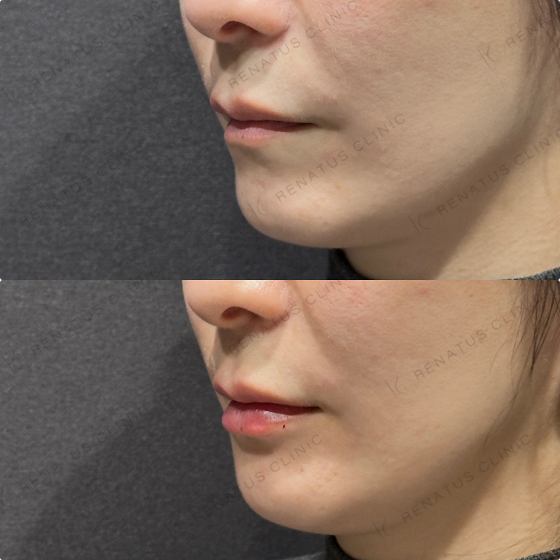 唇ヒアルロン酸ボルベラ症例写真