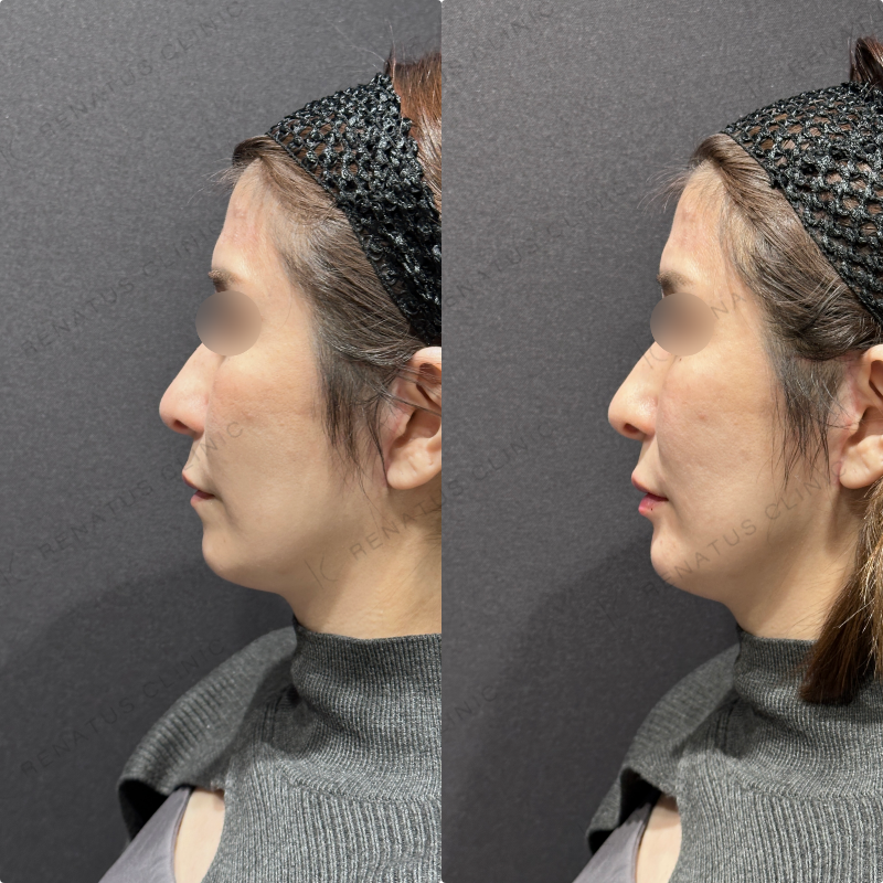 唇ヒアルロン酸ボルベラ症例写真