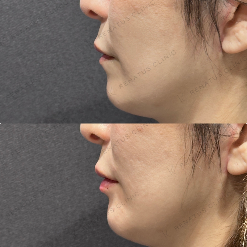 唇ヒアルロン酸ボルベラ症例写真