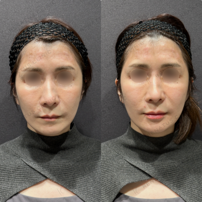 唇ヒアルロン酸ボルベラ症例写真