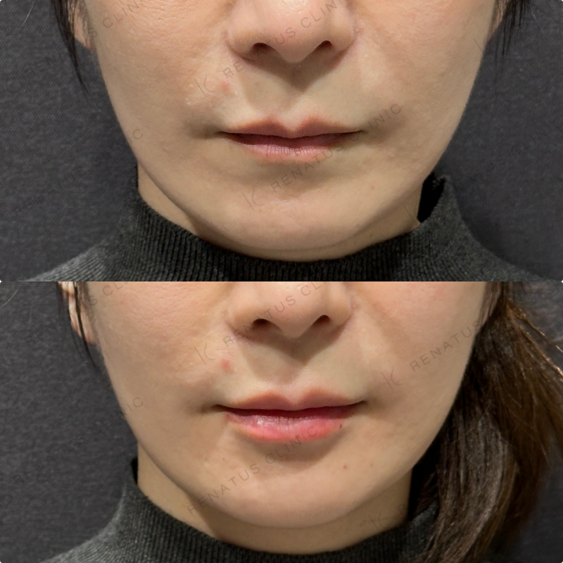 唇ヒアルロン酸ボルベラ症例写真