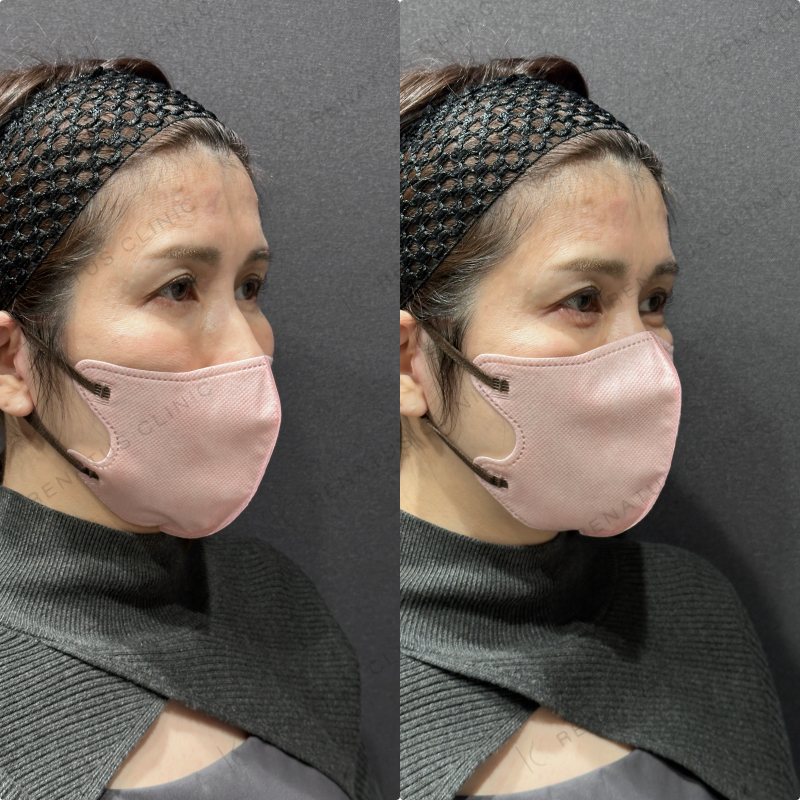 涙袋ヒアルロン酸ボルベラ症例写真