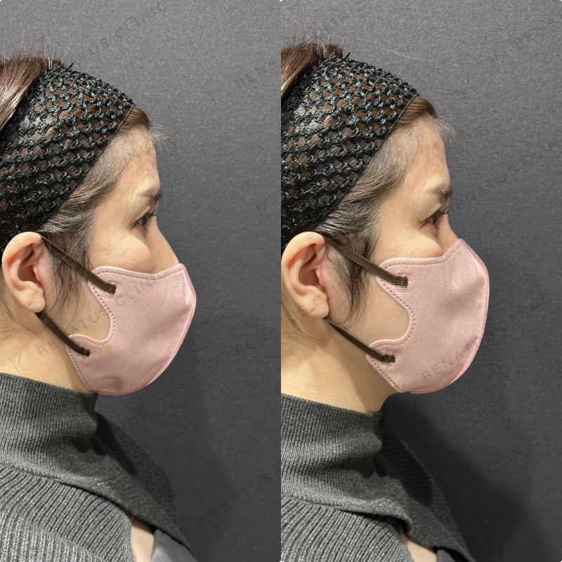 涙袋ヒアルロン酸ボルベラ症例写真