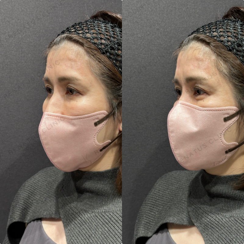 涙袋ヒアルロン酸ボルベラ症例写真