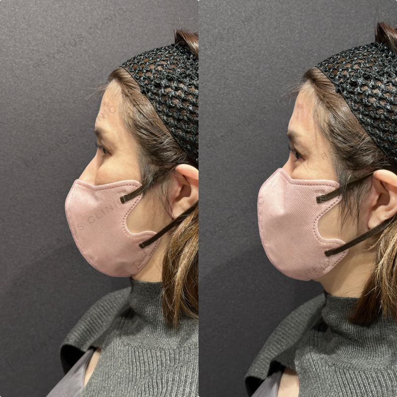 涙袋ヒアルロン酸ボルベラ症例写真