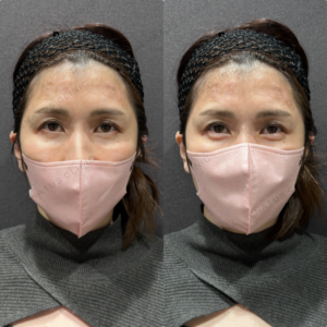 涙袋ヒアルロン酸ボルベラ症例写真の症例写真