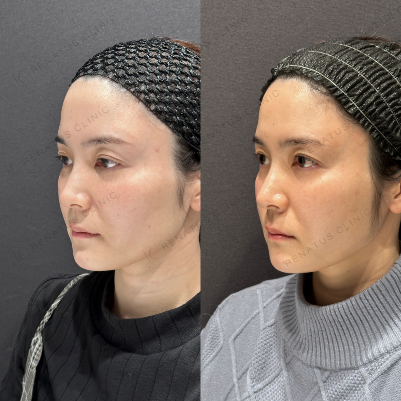 頬ヒアルロン酸ボライト症例写真