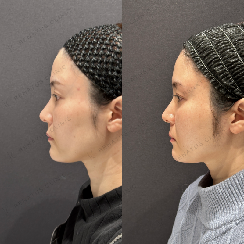 頬ヒアルロン酸ボライト症例写真