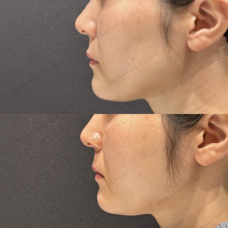 頬ヒアルロン酸ボライト症例写真