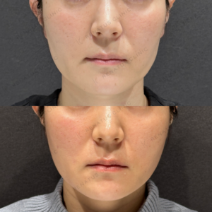 頬ヒアルロン酸ボライト症例写真の症例写真