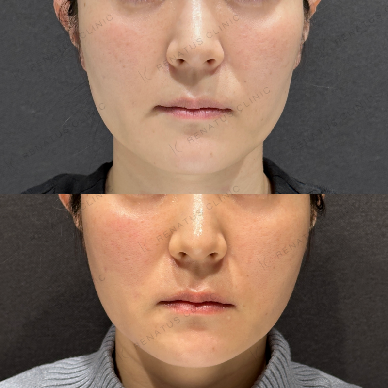 頬ヒアルロン酸ボライト症例写真