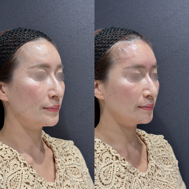 額ヒアルロン酸ボライト症例写真