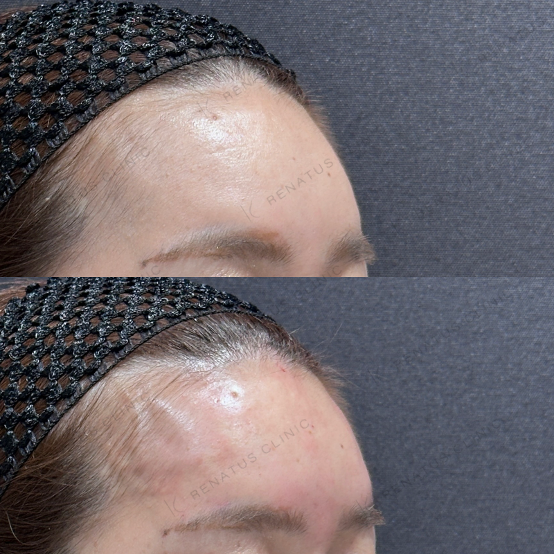 額ヒアルロン酸ボライト症例写真