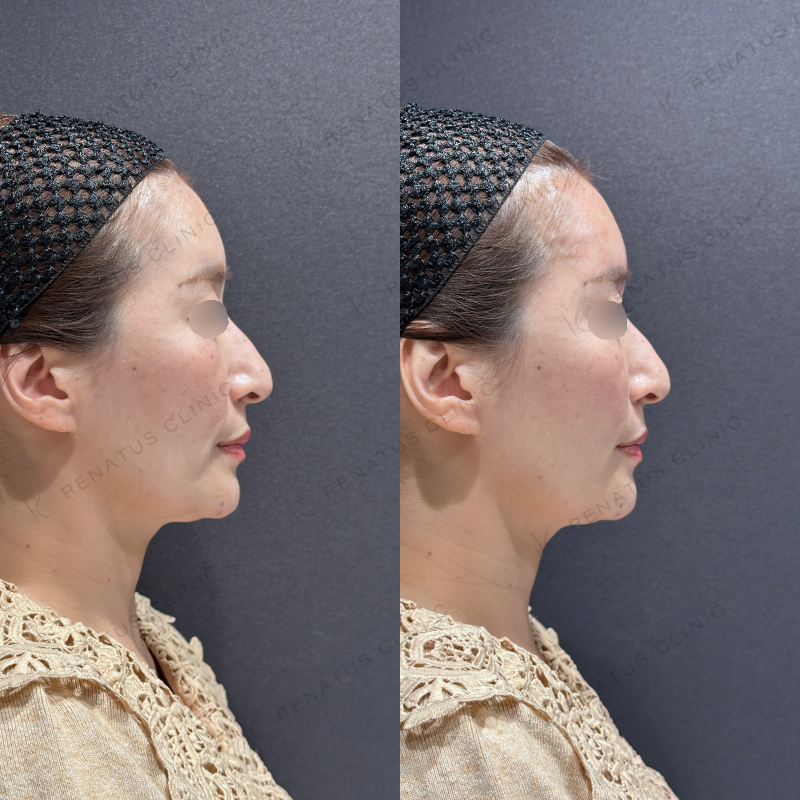 額ヒアルロン酸ボライト症例写真