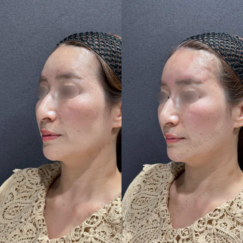 額ヒアルロン酸ボライト症例写真