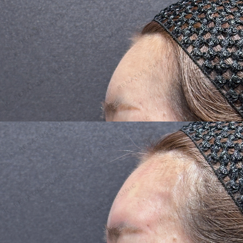 額ヒアルロン酸ボライト症例写真