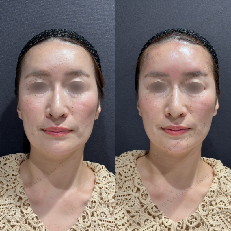 額ヒアルロン酸ボライト症例写真