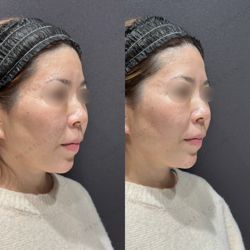 顎ヒアルロン酸ボラックス症例写真