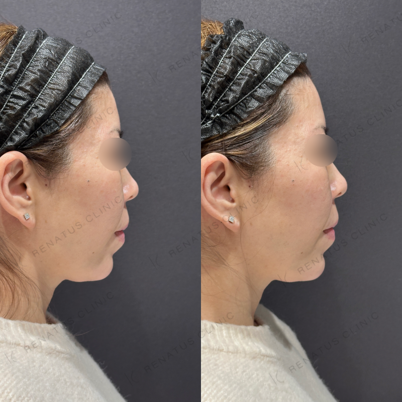 顎ヒアルロン酸ボラックス症例写真