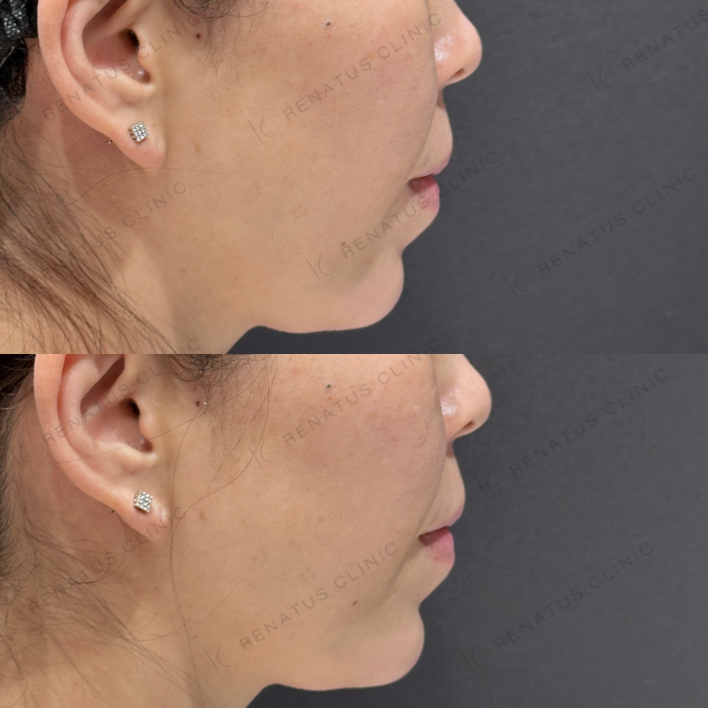 顎ヒアルロン酸ボラックス症例写真