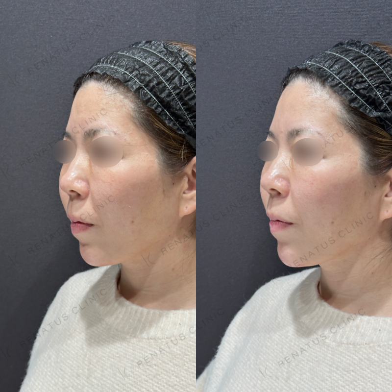 顎ヒアルロン酸ボラックス症例写真