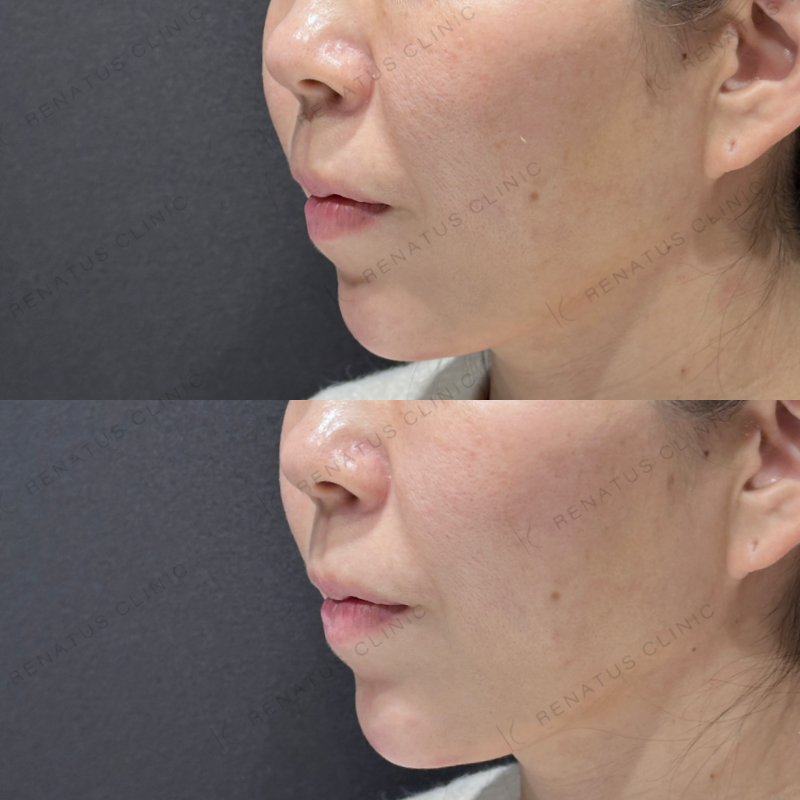 顎ヒアルロン酸ボラックス症例写真