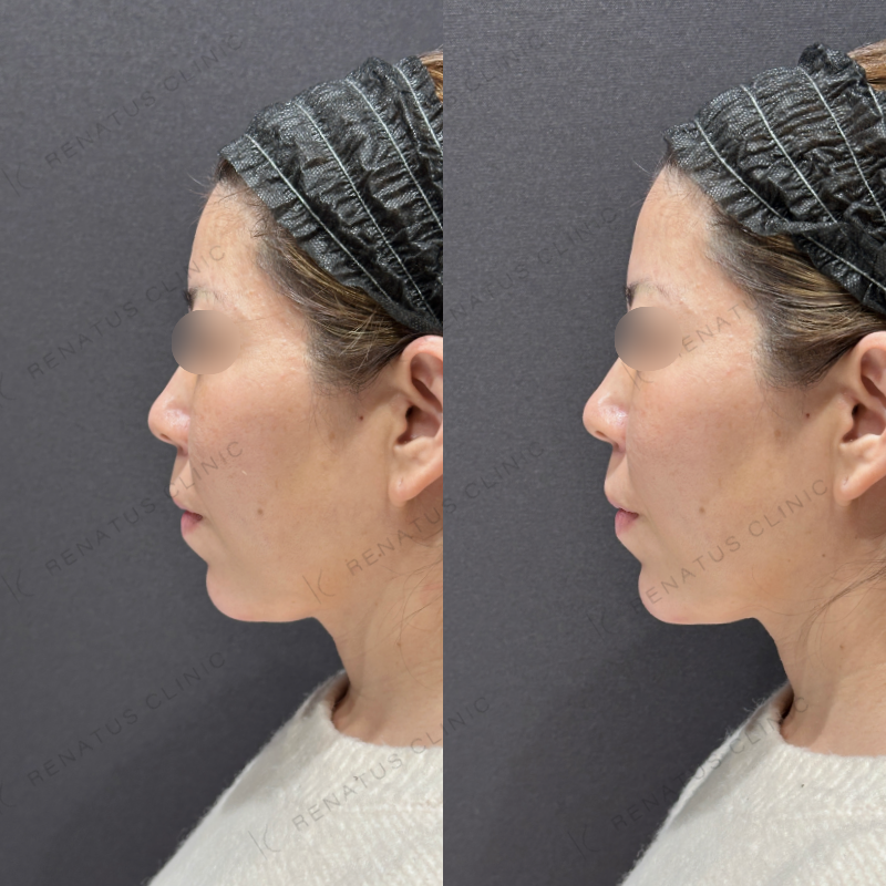 顎ヒアルロン酸ボラックス症例写真