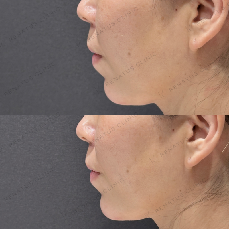 顎ヒアルロン酸ボラックス症例写真