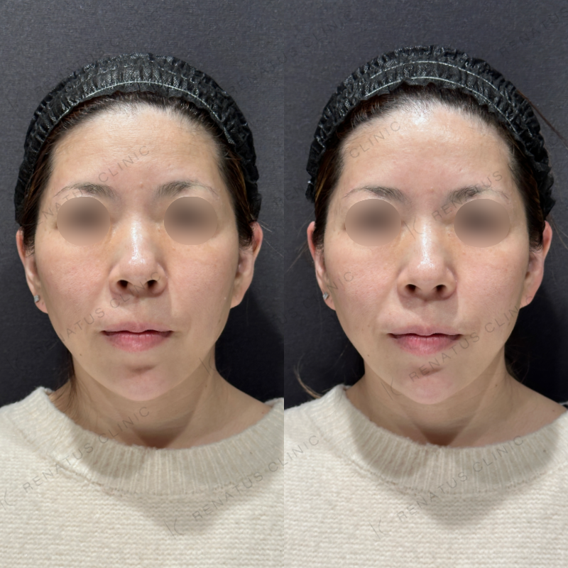 顎ヒアルロン酸ボラックス症例写真