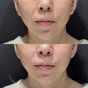 顎ヒアルロン酸ボラックス症例写真の症例写真