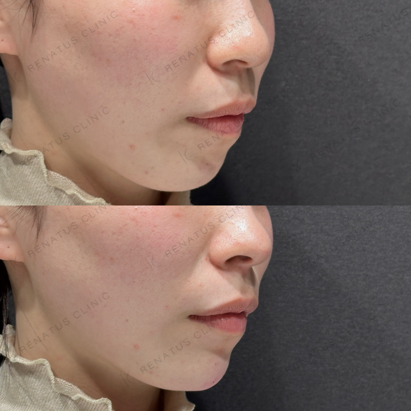 鼻顎ヒアルロン酸ボラックス症例写真