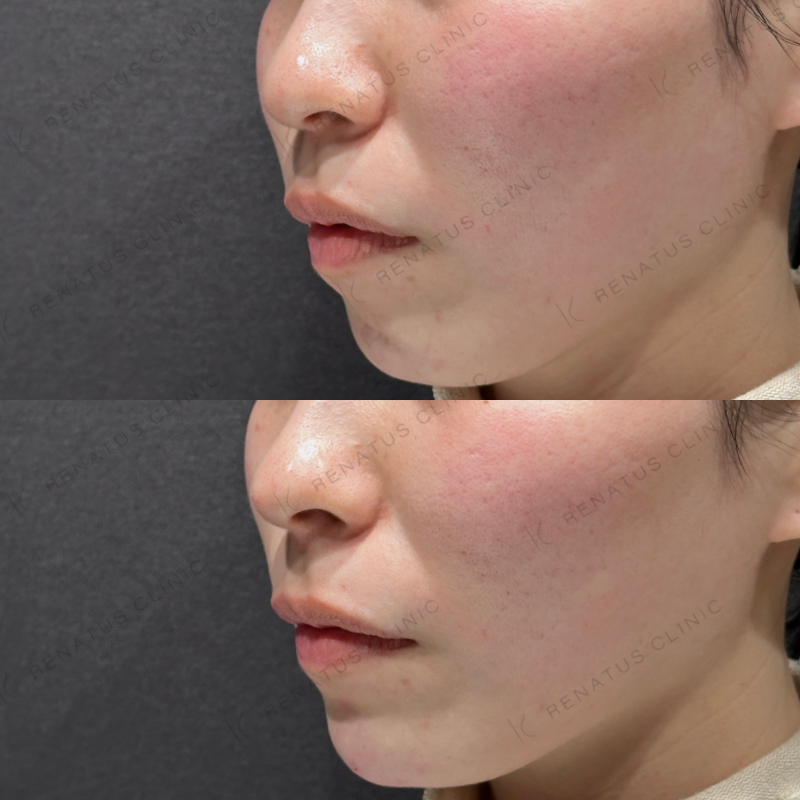 鼻顎ヒアルロン酸ボラックス症例写真