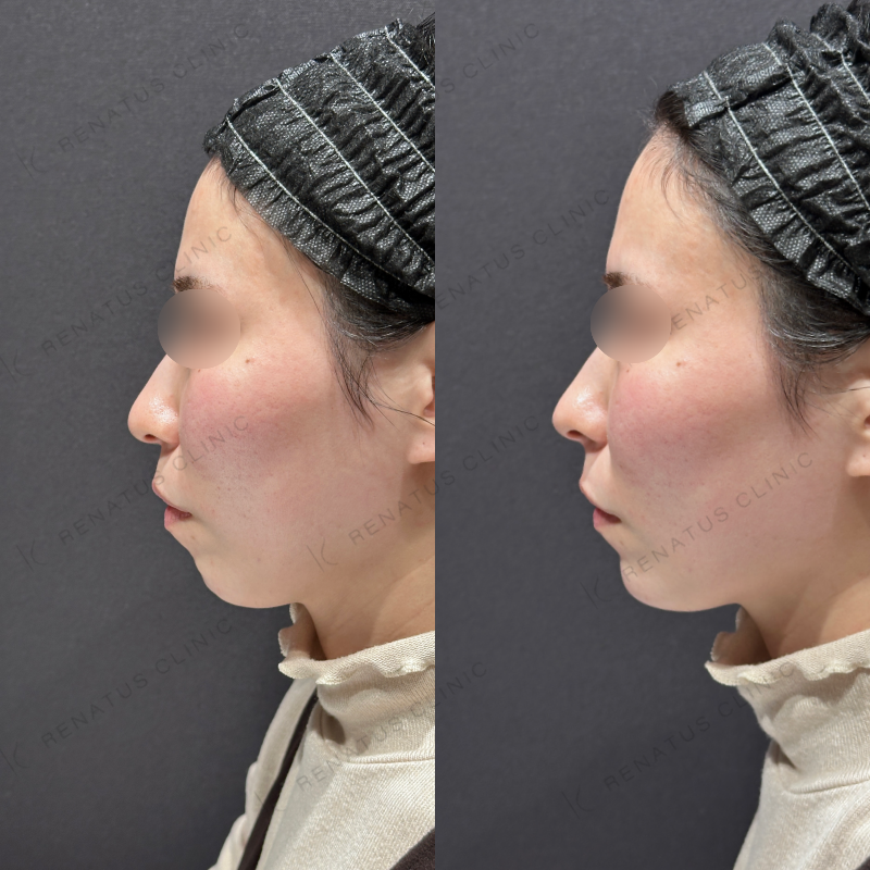 鼻顎ヒアルロン酸ボラックス症例写真