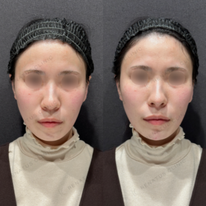 鼻顎ヒアルロン酸ボラックス症例写真の症例写真