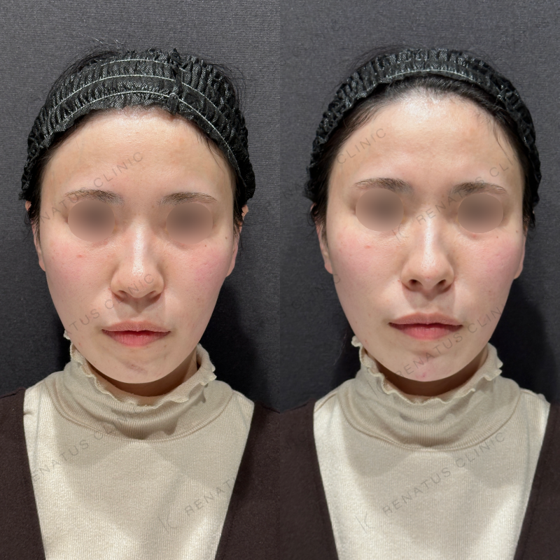 鼻顎ヒアルロン酸ボラックス症例写真
