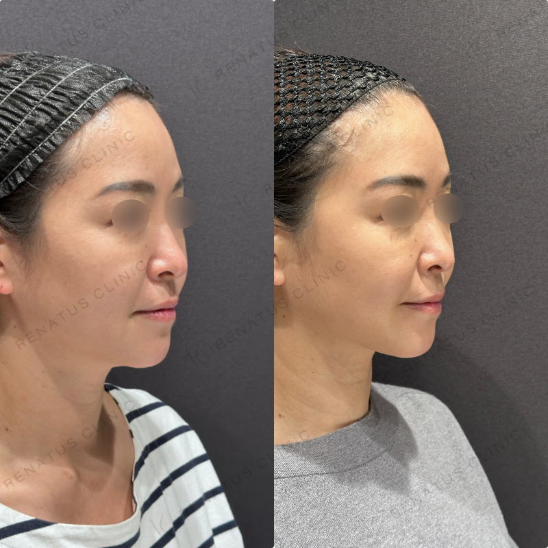 糸リフト症例写真