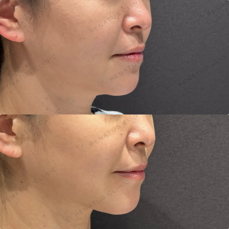 糸リフト症例写真