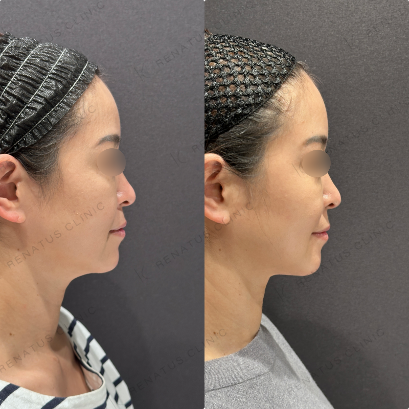 糸リフト症例写真