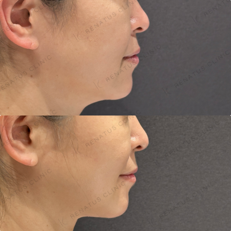 糸リフト症例写真