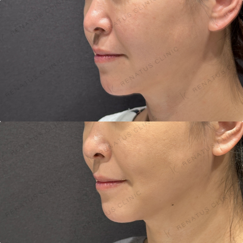 糸リフト症例写真