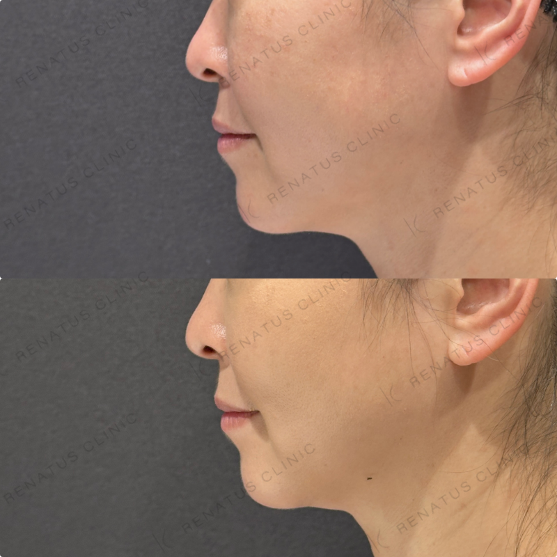 糸リフト症例写真